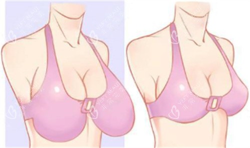 巨乳缩小术