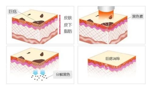 激光去痣过程 激光去痣过程