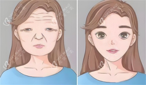 面部抗衰