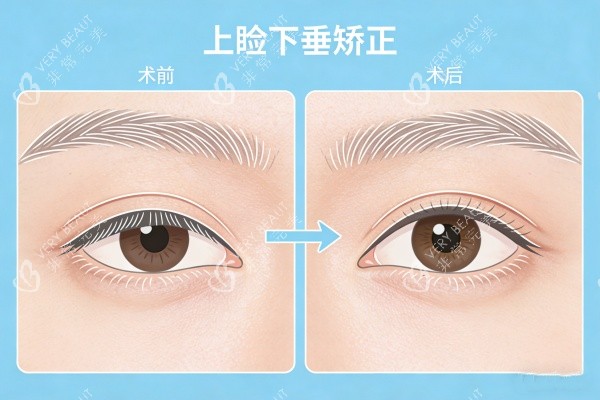 上睑下垂矫正前后对比图