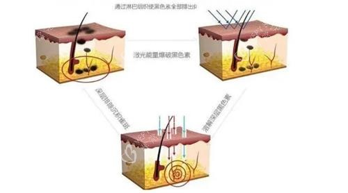 激光去痣原理 激光去痣原理