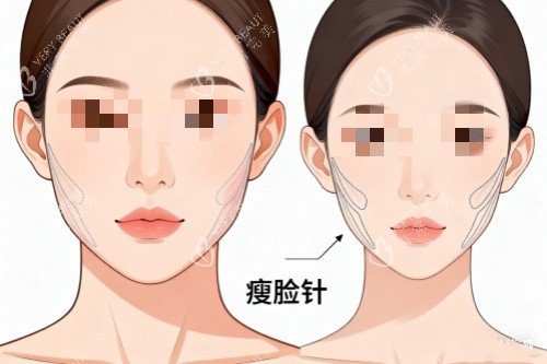 针剂注射瘦脸对比图.jpg