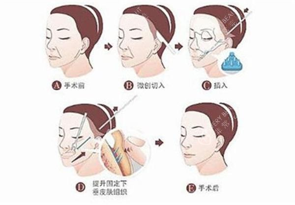 拉皮手术全过程.jpg