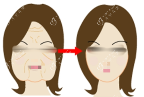 打针瘦脸前后对比图.png