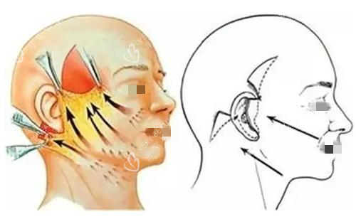 拉皮手术缝合前后示意图.png