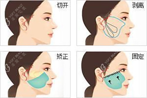 面部耳际小切口拉皮示意图.jpg