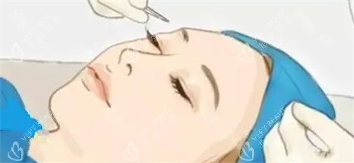 双眼皮手术过程卡通图.jpg