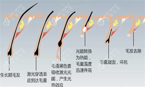 光电仪器脱毛前后对比.jpg