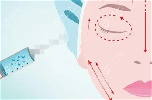 玻尿酸面部填充示意图.png