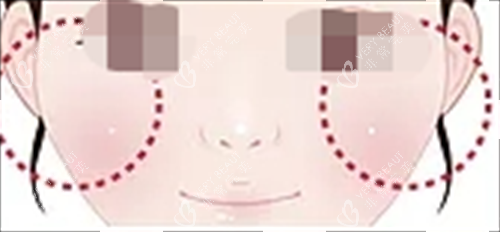 玻尿酸填充眼下填充.png