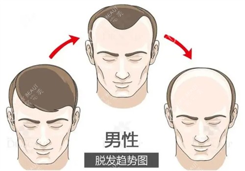 脱发趋势图.jpg