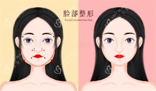 面部轮廓前后对比卡通图展示.jpg 面部轮廓前后对比卡通图展示.jpg