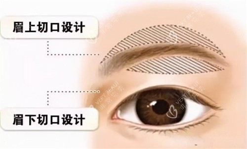 提眉手术切口动画演示图.jpg 提眉手术切口动画演示图.jpg