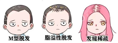 脱发种类.jpg